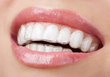 assets/images/braces/invisalign-teen.jpg