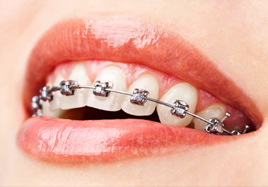 assets/images/braces/metal.jpg