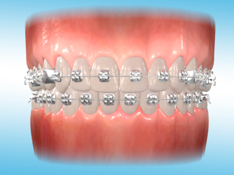 assets/images/glossary/ceramic-bracket.jpg