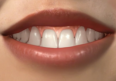 assets/images/glossary/gingiva.jpg