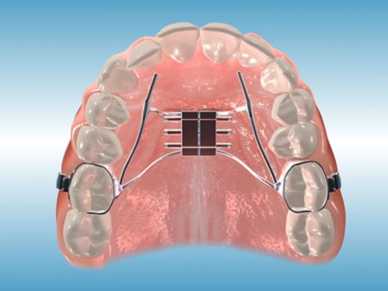 assets/images/orthodontic_appliances/palatal-expander.jpg