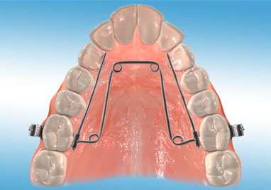 assets/images/orthodontic_appliances/quadhelix.jpg